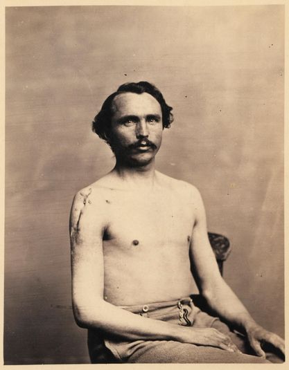 Private Adolph Zirsse, Successful Intermediate Excision of the Head and two and a half inches of the Shaft of the Right Humerus, from the Photographic Catalogue of the Surgical Section